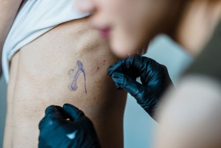 Remoção de tatuagem a laser em São Paulo: guia técnico completo