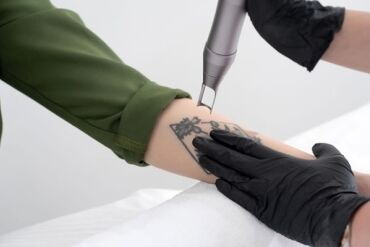 Remoção de Tatuagem com Laser em São Paulo: Tratamento, Resultados e Preço