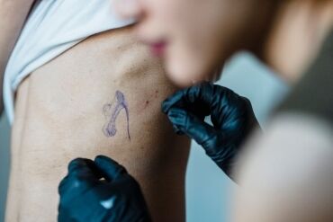 Remoção de tatuagem a laser em São Paulo: guia técnico completo