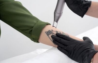 Remoção de Tatuagem com Laser em São Paulo: Tratamento, Resultados e Preço